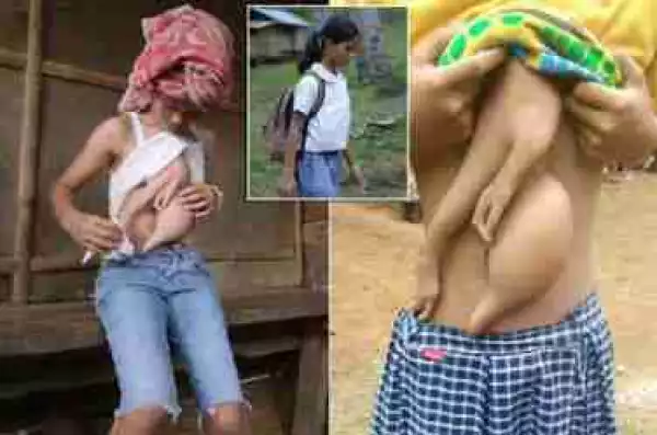 14-Year-Old Girl Grows ‘Twin Sister’ On Her Chest In Philippines (Disturbing Photos)